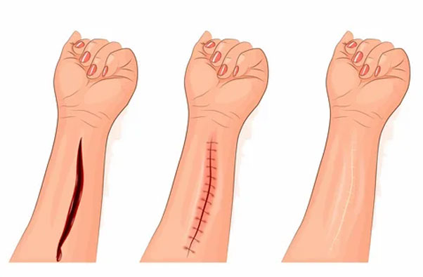 How to Identify and Repair a Laceration Like a Professional